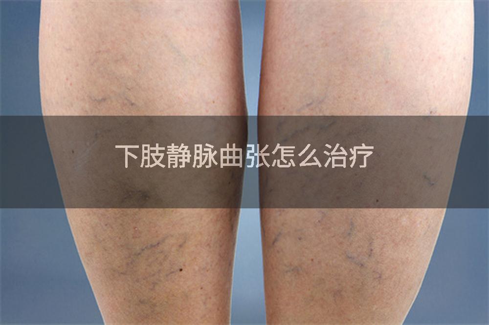 下肢静脉曲张怎么治疗