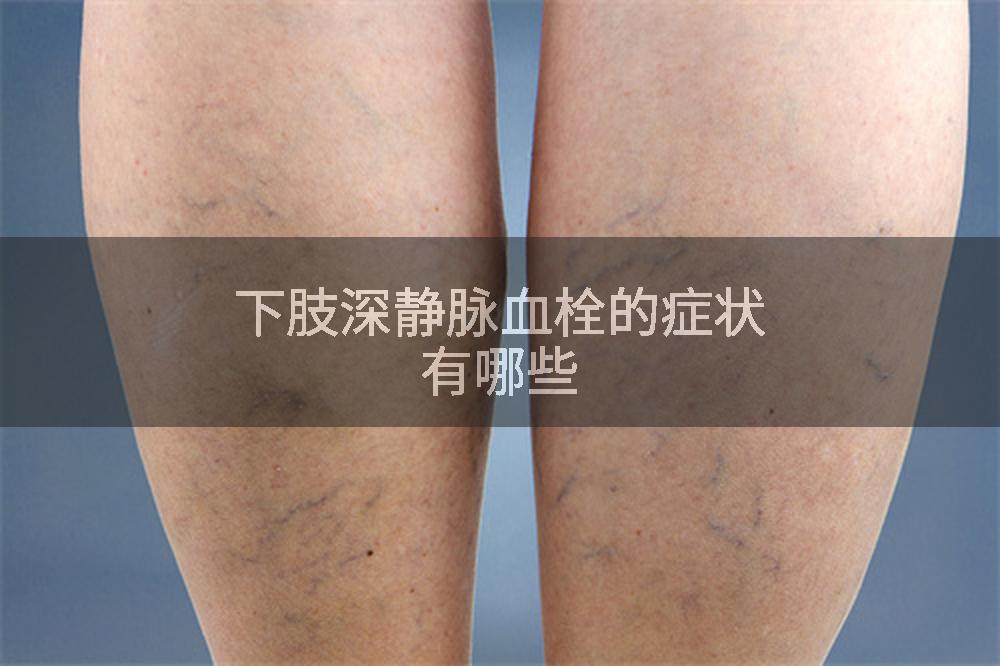 下肢深静脉血栓的症状有哪些