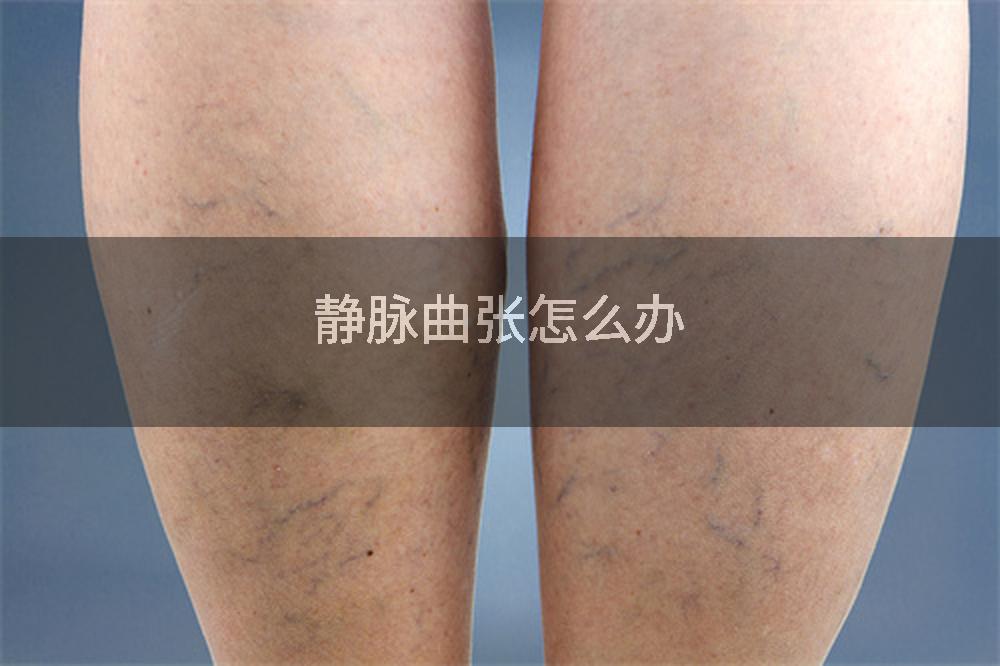 静脉曲张怎么办