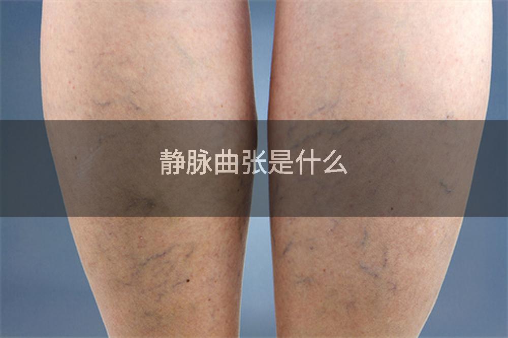 静脉曲张是什么