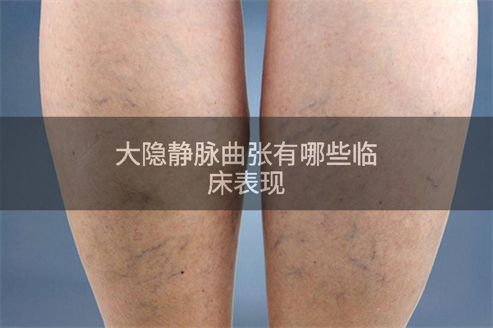 大隐静脉曲张有哪些临床表现