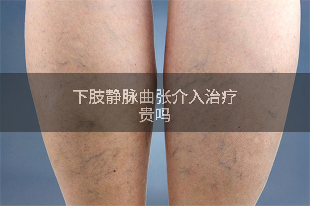 下肢静脉曲张介入治疗贵吗