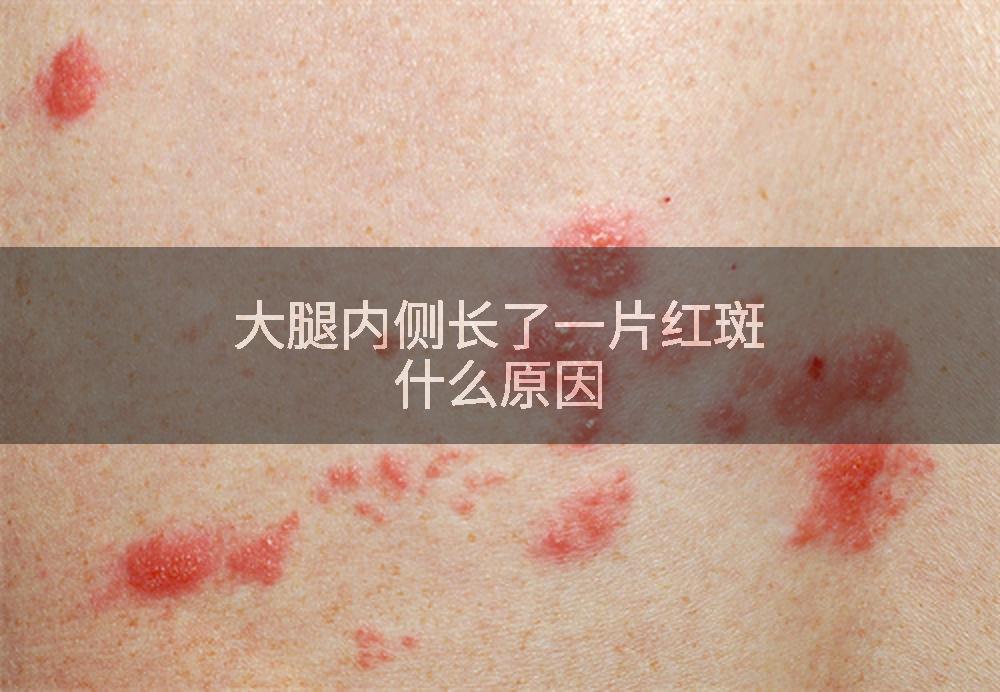 大腿内侧长了一片红斑什么原因