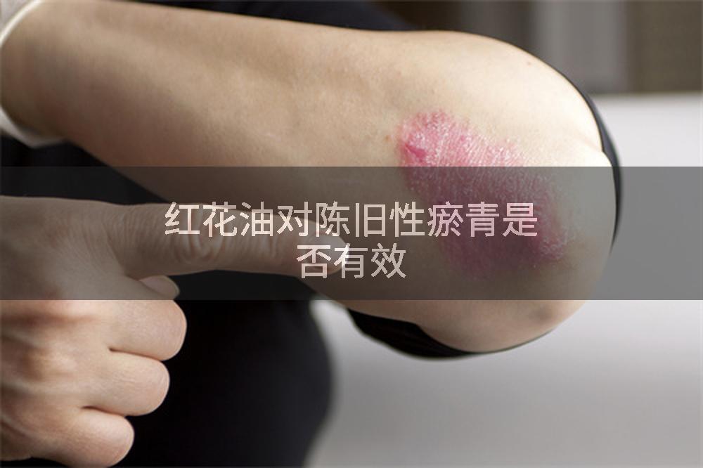 红花油对陈旧性瘀青是否有效