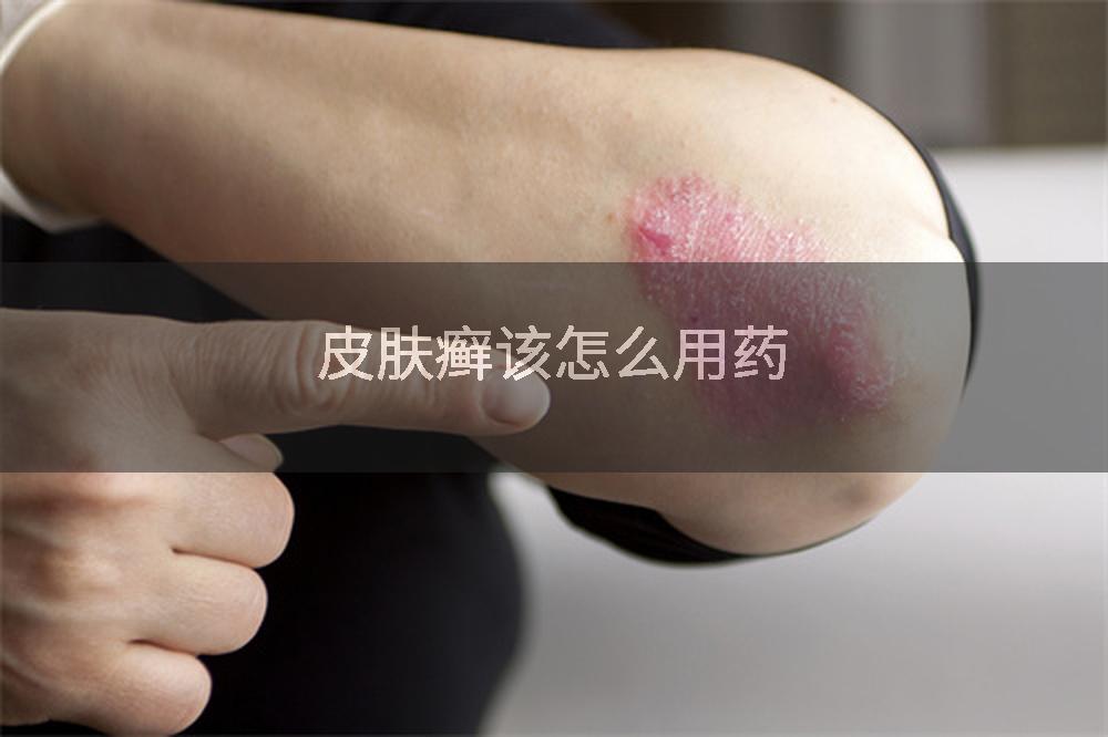 皮肤癣该怎么用药