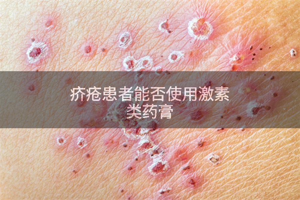 疥疮患者能否使用激素类药膏