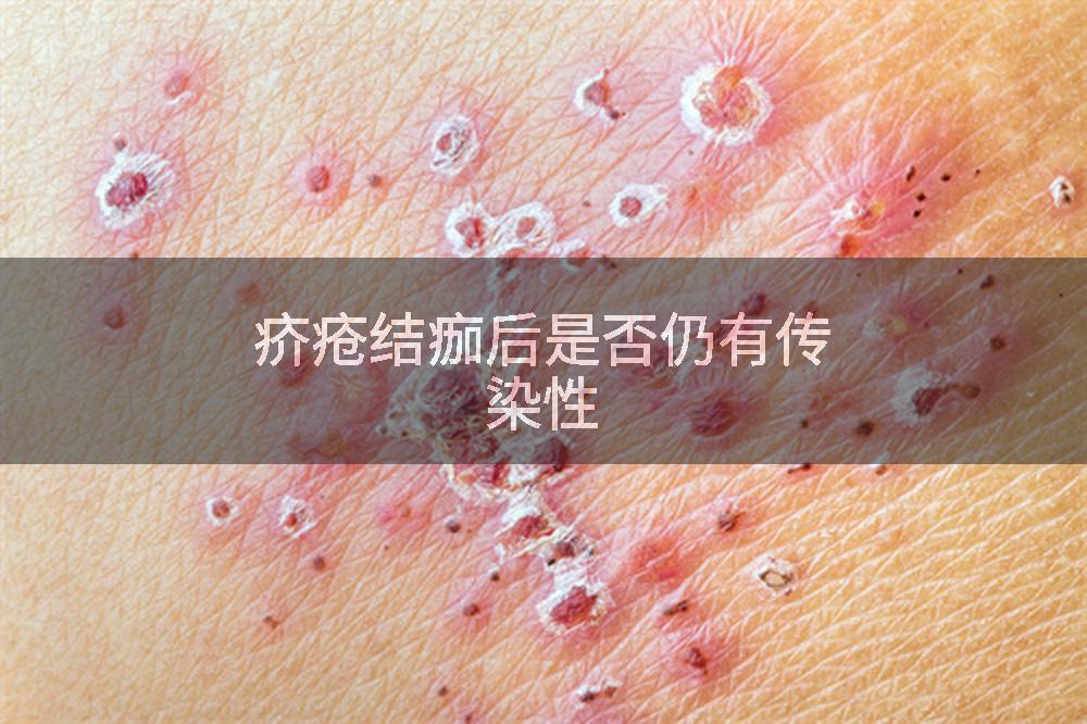 疥疮结痂后是否仍有传染性