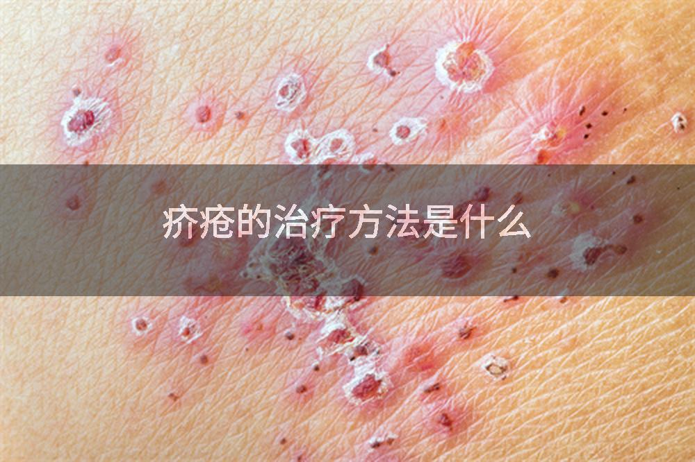 疥疮的治疗方法是什么