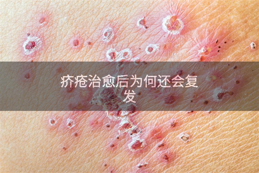 疥疮治愈后为何还会复发