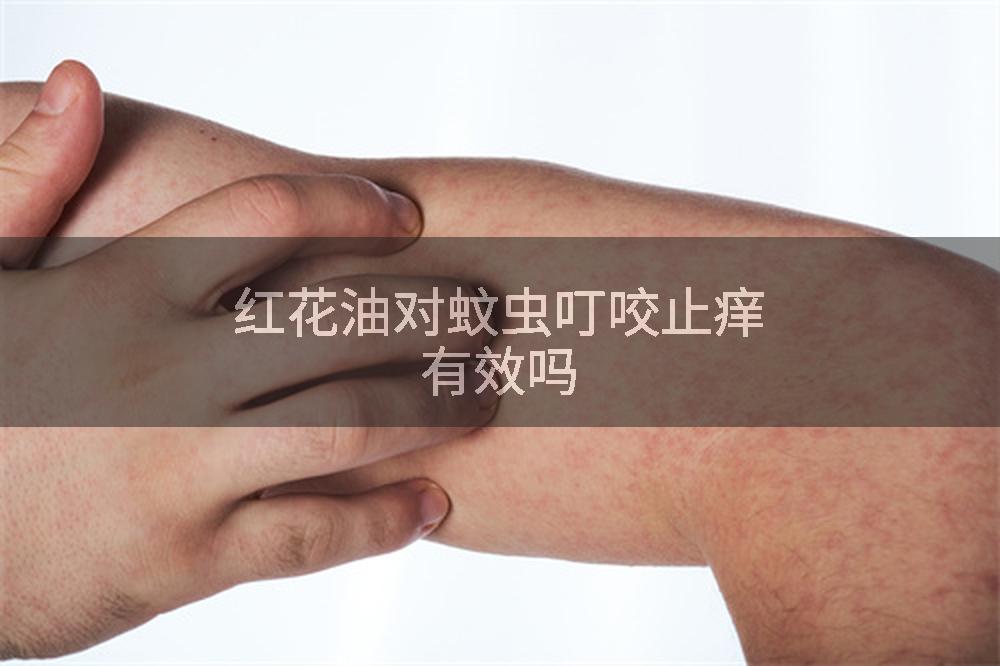 红花油对蚊虫叮咬止痒有效吗