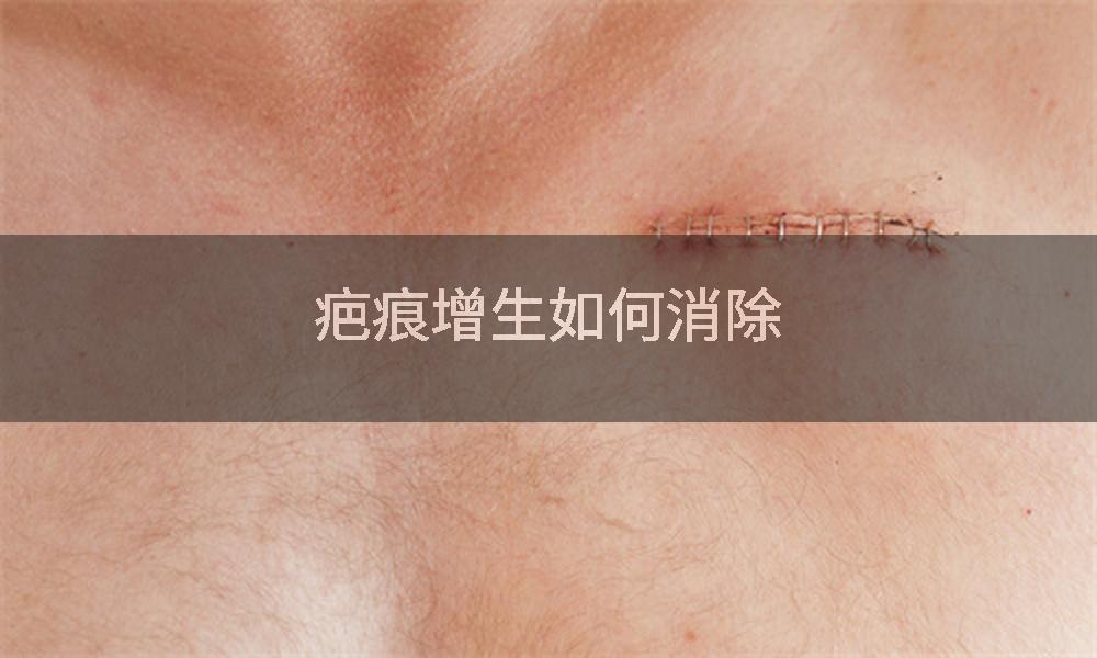 疤痕增生如何消除