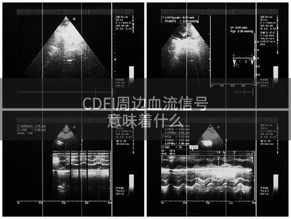 CDFI周边血流信号意味着什么