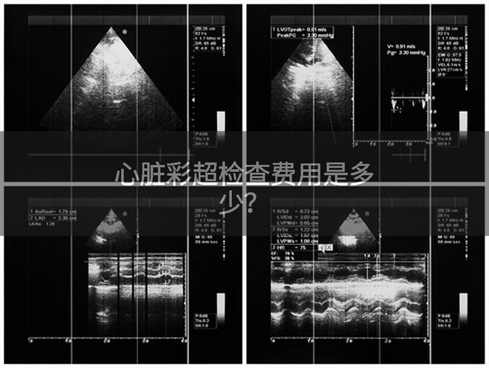 心脏彩超检查费用是多少?