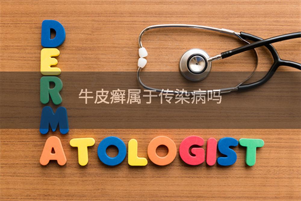 牛皮癣属于传染病吗