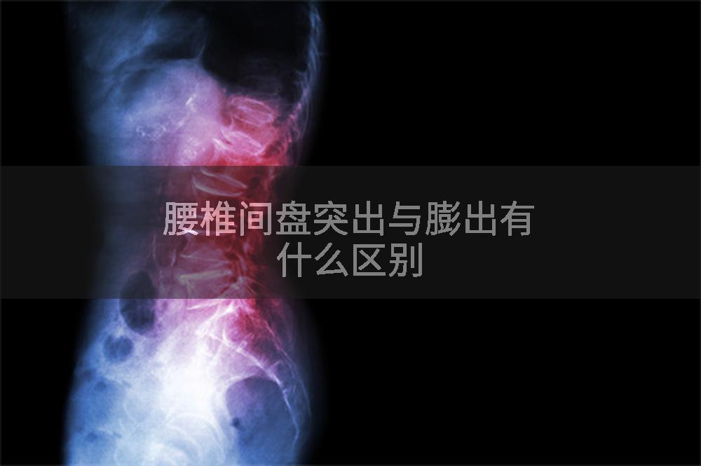 腰椎间盘突出与膨出有什么区别