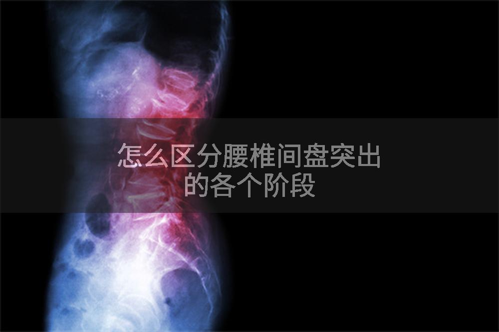 怎么区分腰椎间盘突出的各个阶段
