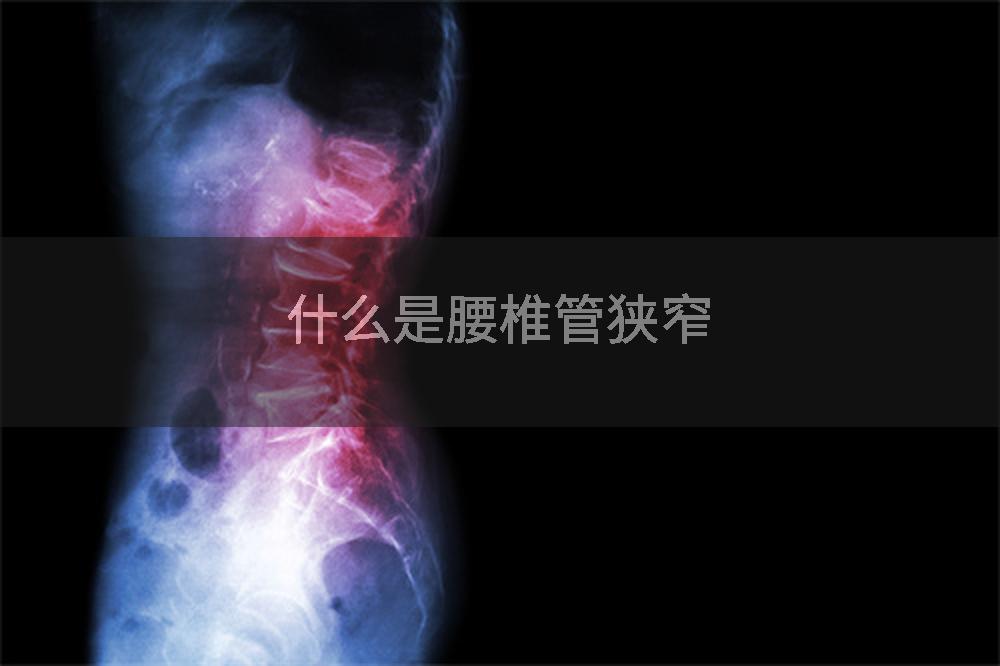 什么是腰椎管狭窄