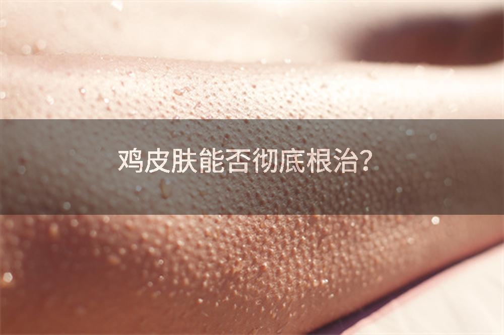 鸡皮肤能否彻底根治？