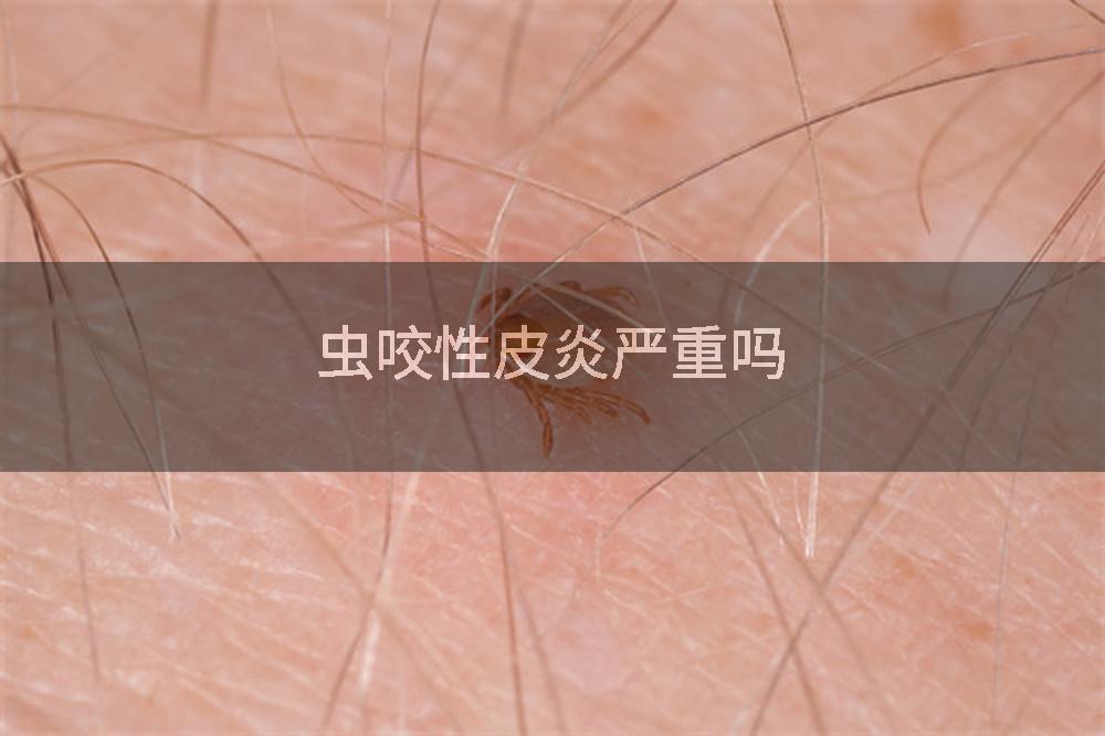 虫咬性皮炎严重吗
