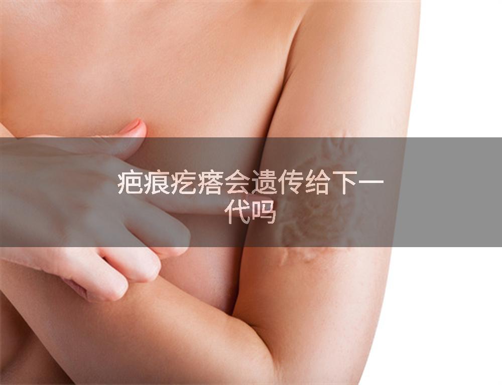 疤痕疙瘩会遗传给下一代吗