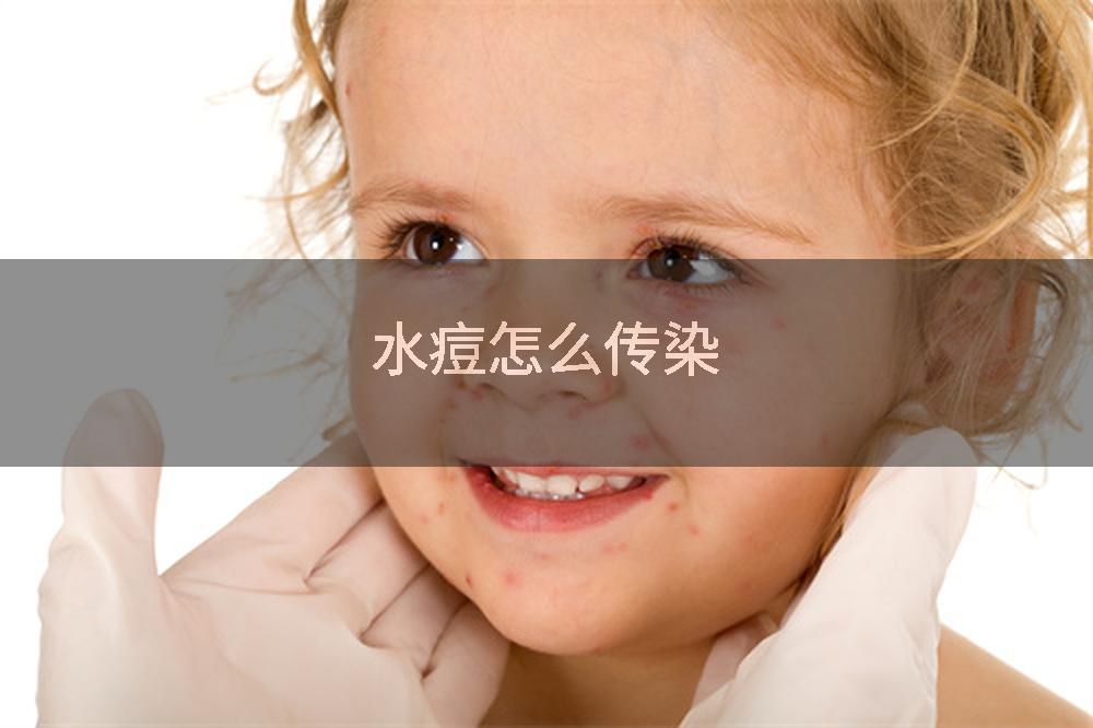 水痘怎么传染