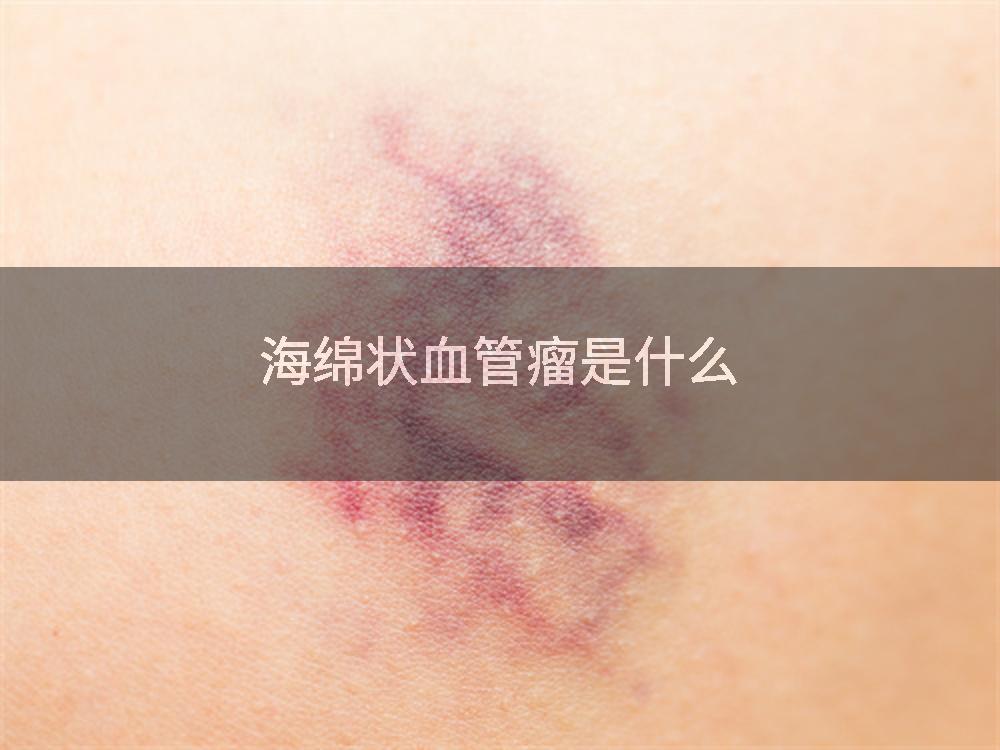 海绵状血管瘤是什么
