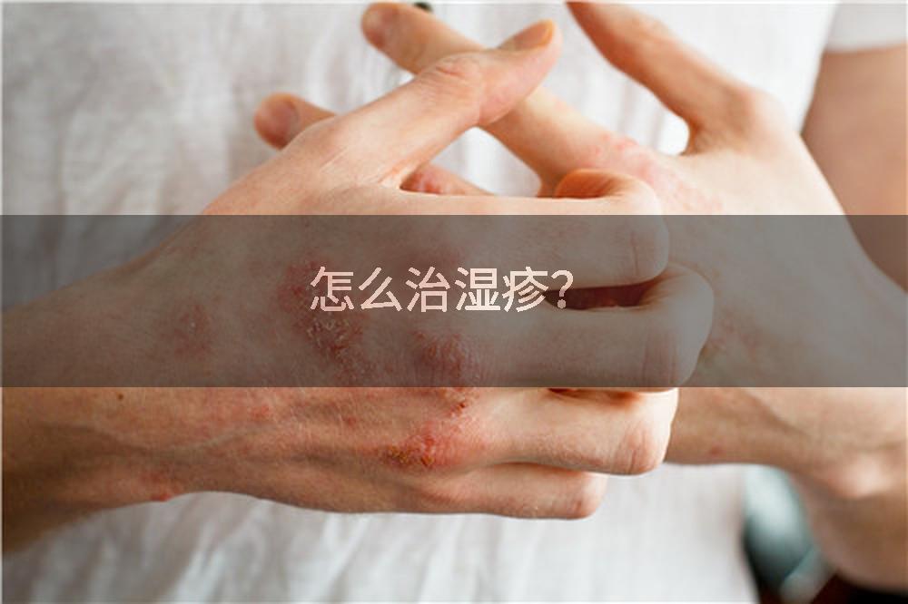 怎么治湿疹？