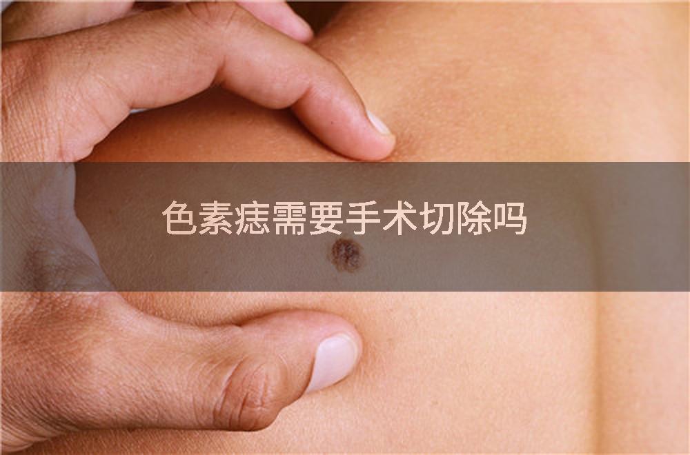 色素痣需要手术切除吗