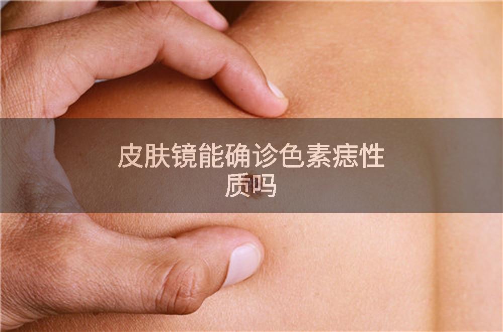 皮肤镜能确诊色素痣性质吗