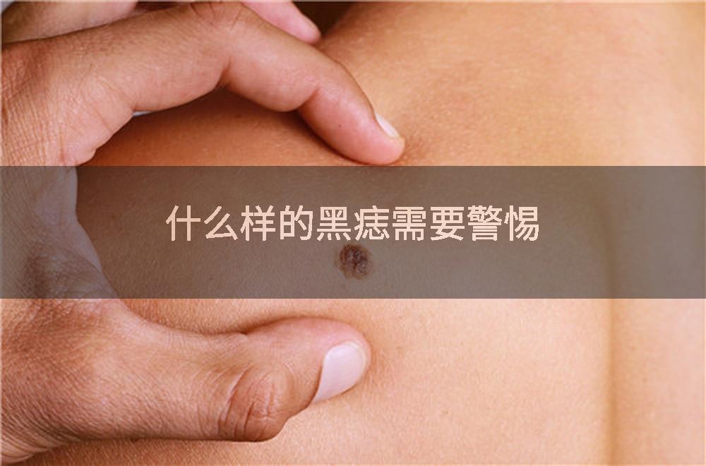 什么样的黑痣需要警惕