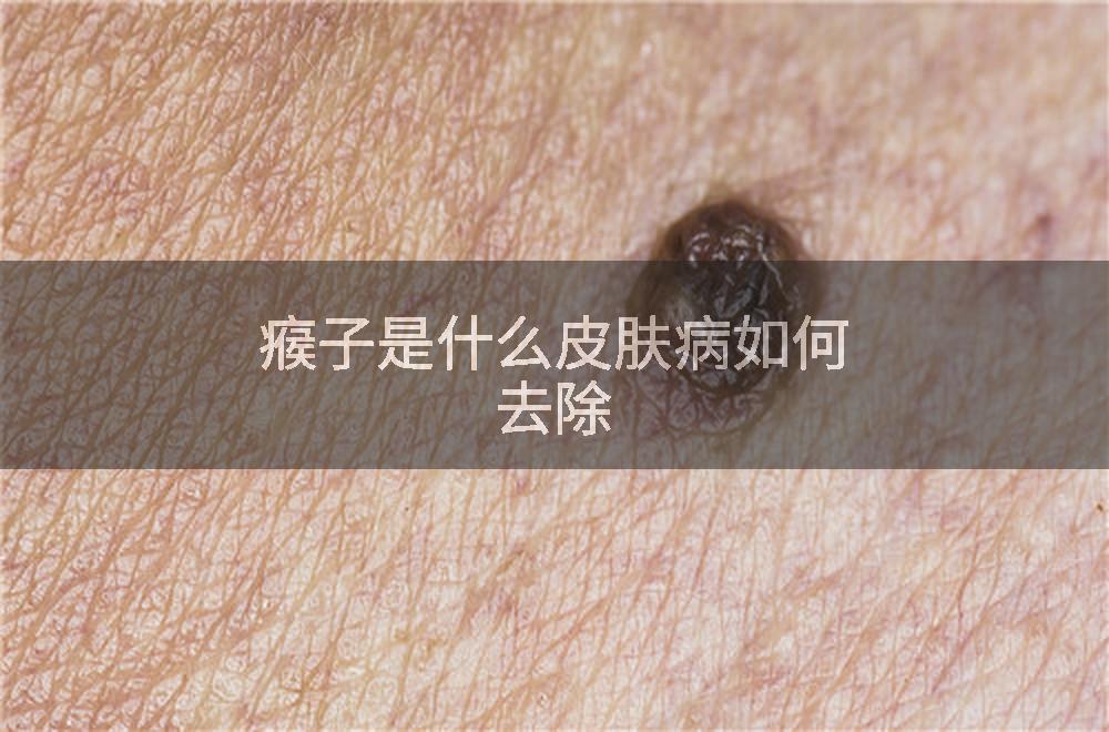 瘊子是什么皮肤病如何去除