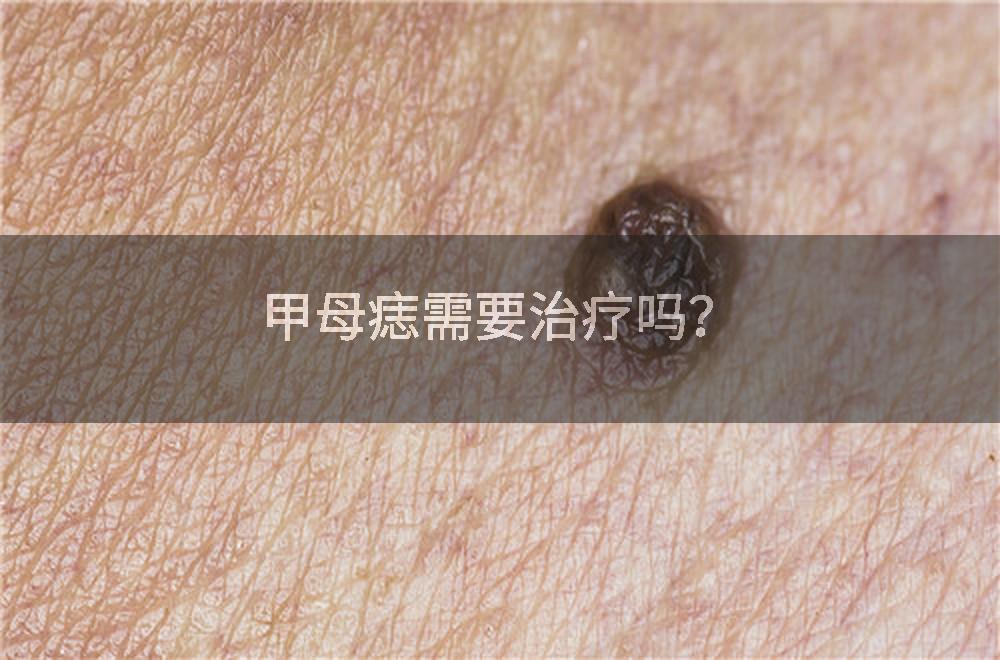 甲母痣需要治疗吗？