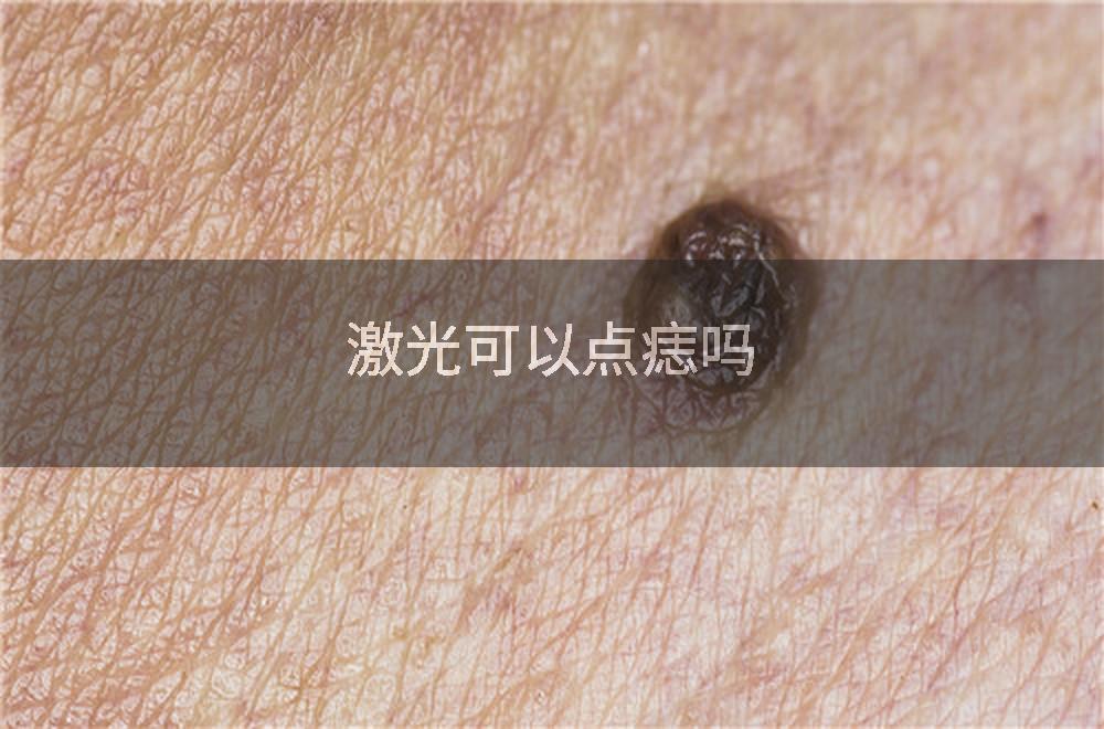 激光可以点痣吗