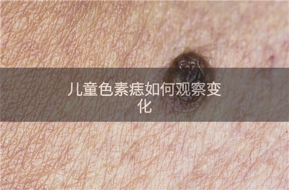 儿童色素痣如何观察变化