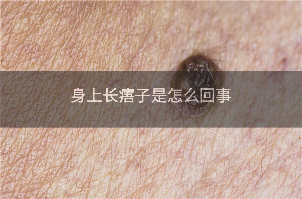 身上长痦子是怎么回事