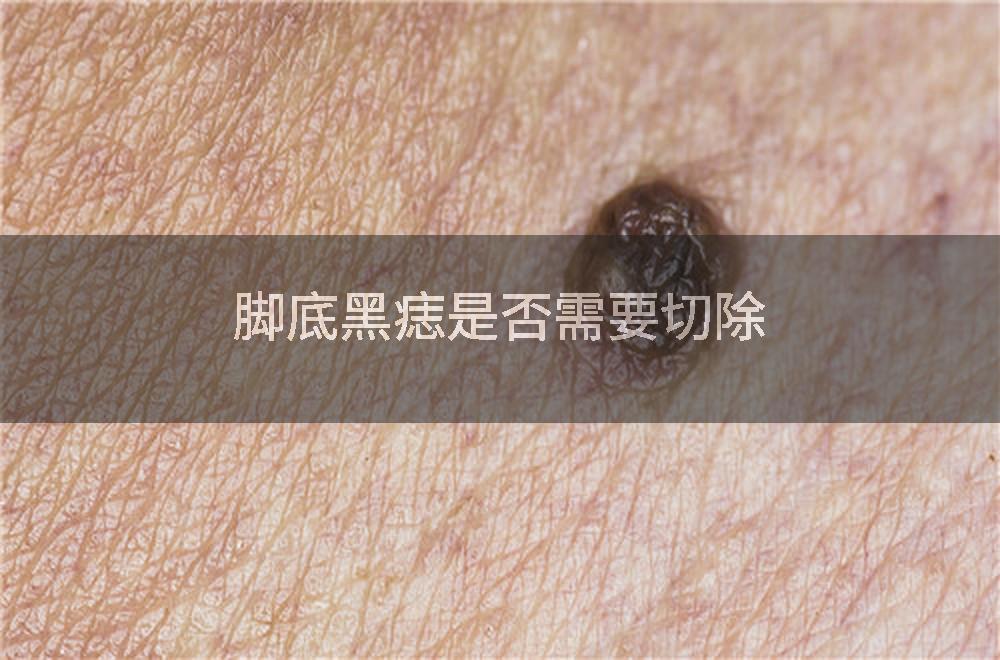 脚底黑痣是否需要切除