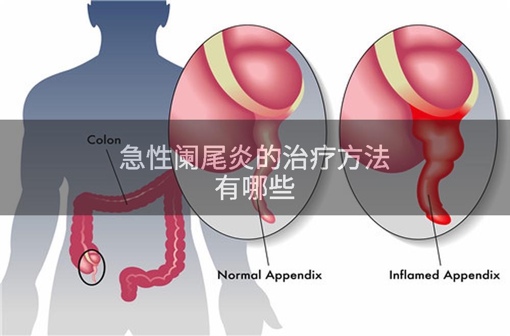 急性阑尾炎的治疗方法有哪些