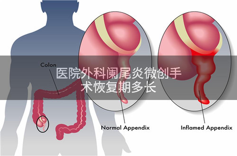 医院外科阑尾炎微创手术恢复期多长
