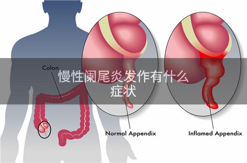 慢性阑尾炎发作有什么症状