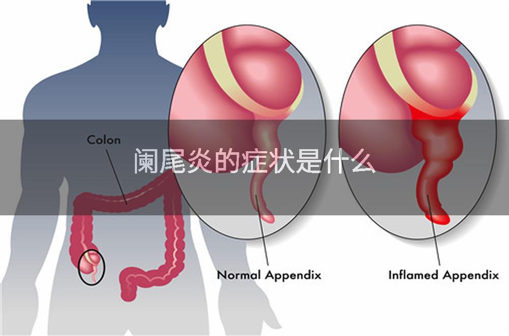 阑尾炎的症状是什么