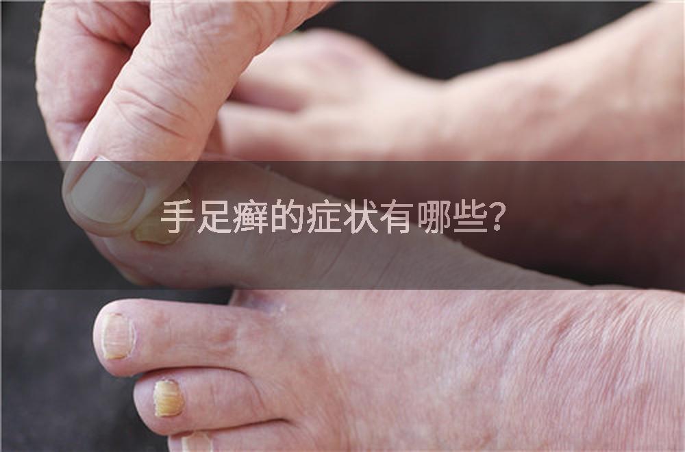 手足癣的症状有哪些？