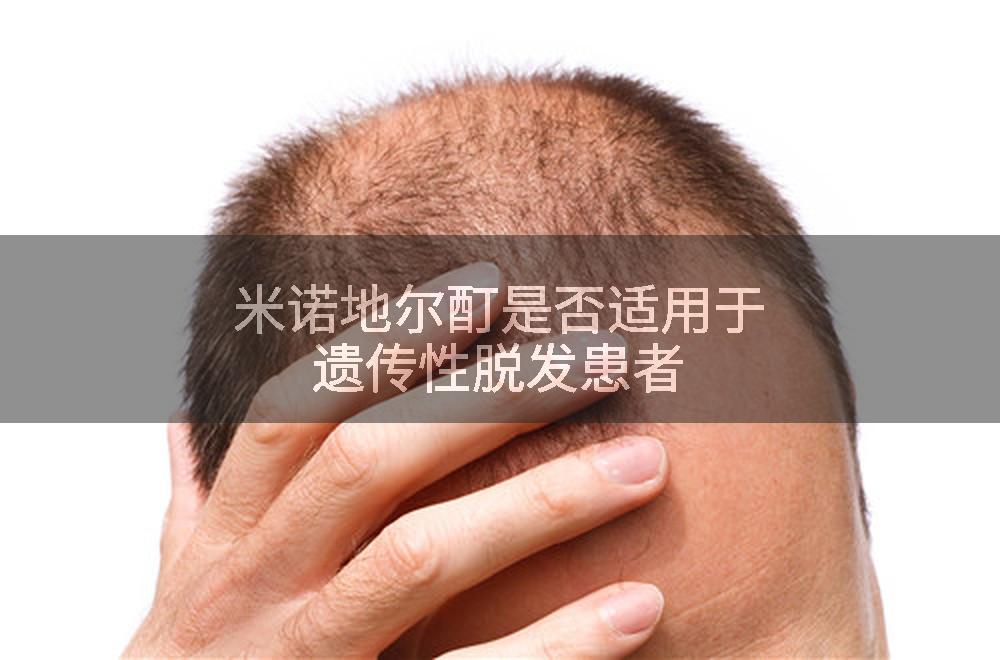 米诺地尔酊是否适用于遗传性脱发患者