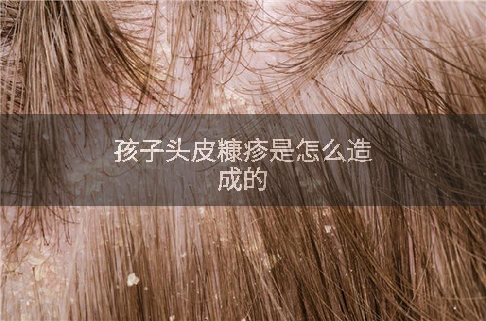 孩子头皮糠疹是怎么造成的