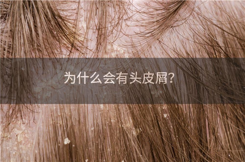 为什么会有头皮屑？