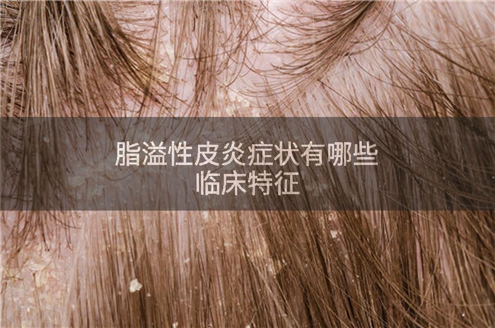 脂溢性皮炎症状有哪些临床特征