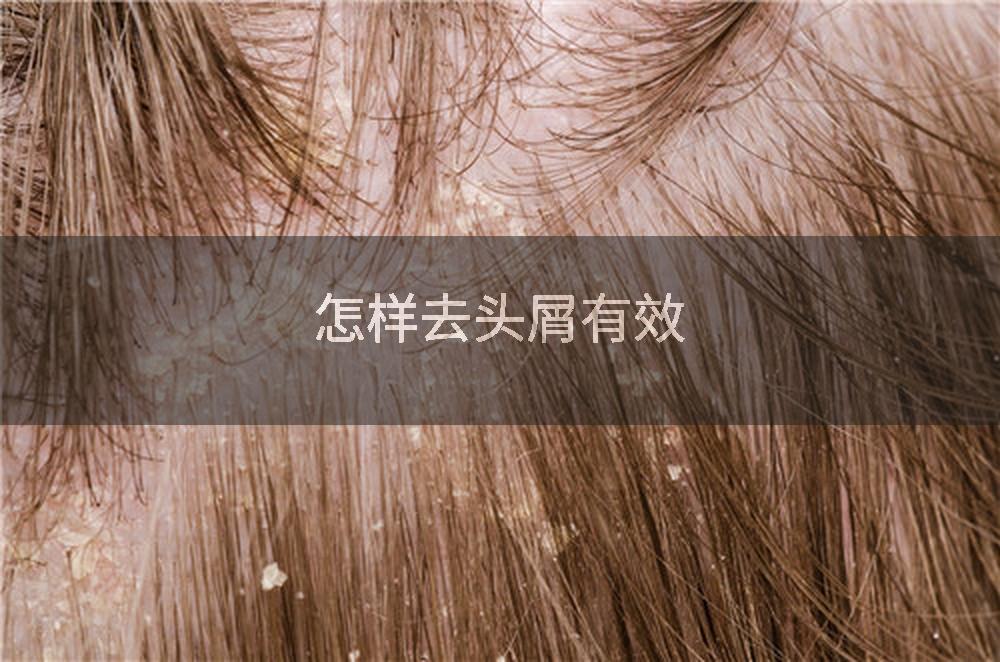 怎样去头屑有效
