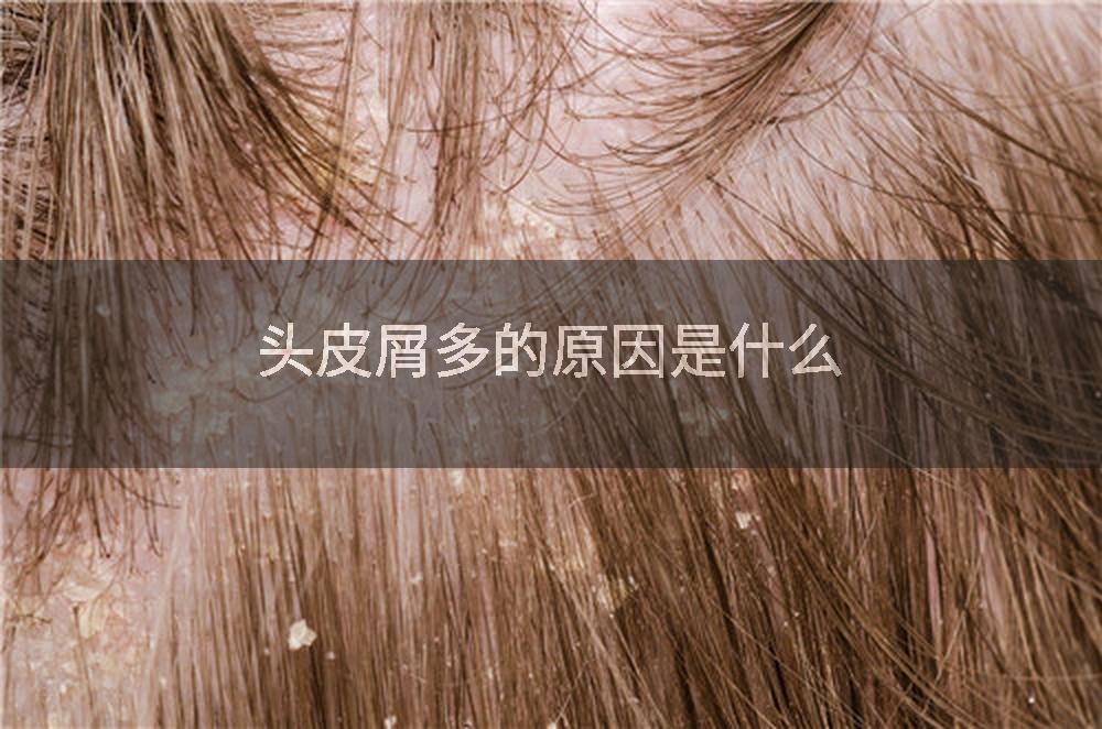 头皮屑多的原因是什么