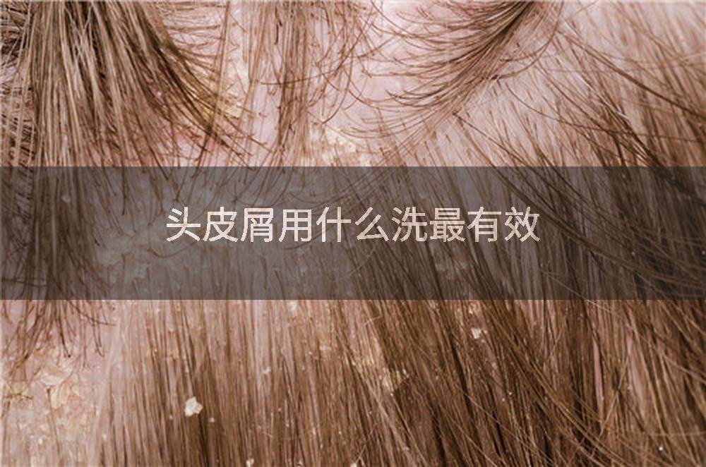 头皮屑用什么洗最有效