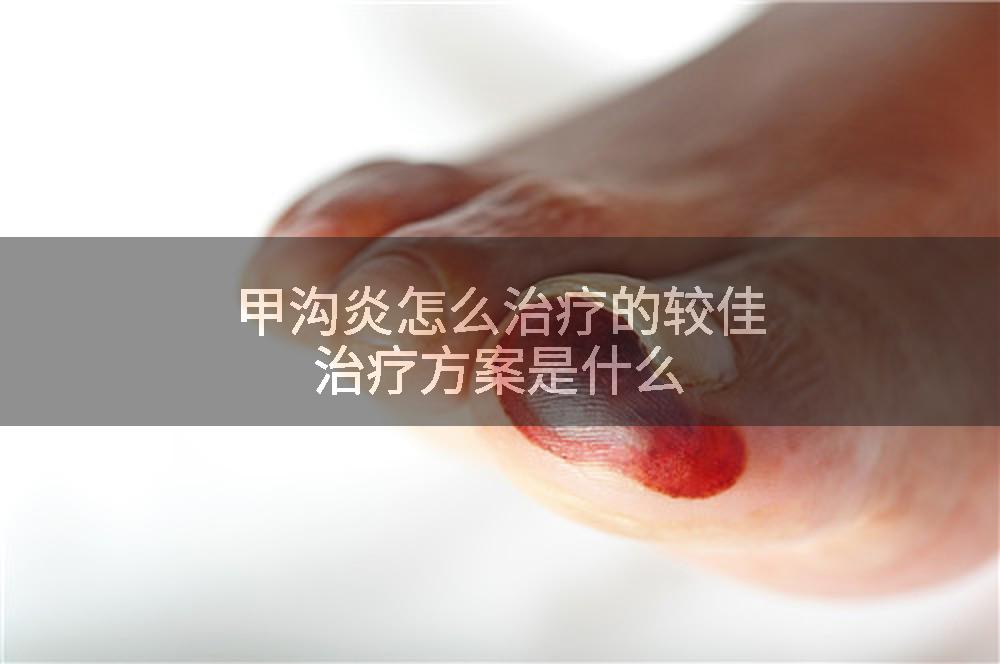 甲沟炎怎么治疗的较佳治疗方案是什么