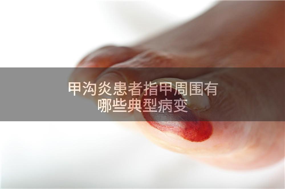 甲沟炎患者指甲周围有哪些典型病变